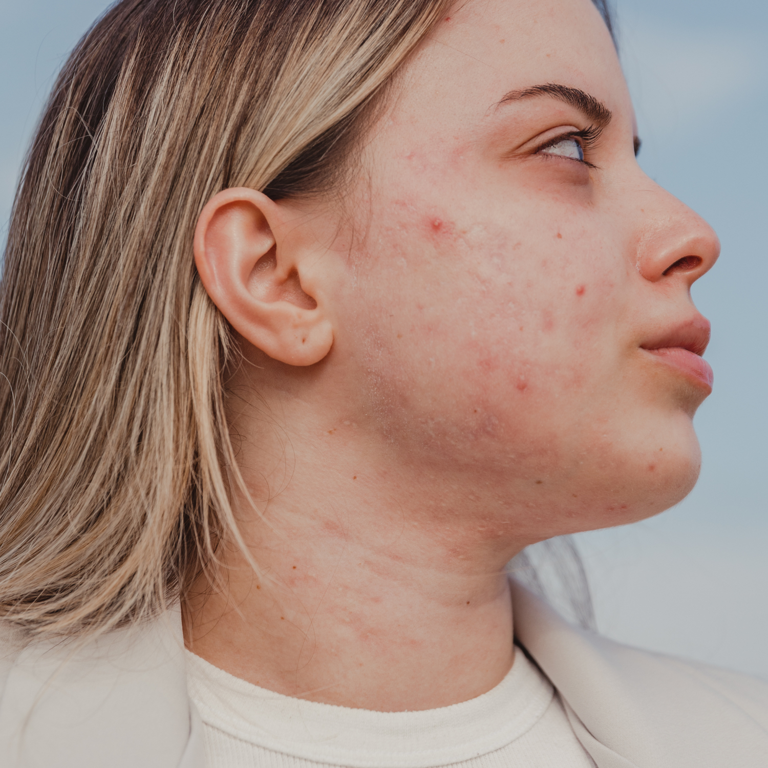 Acne Prone